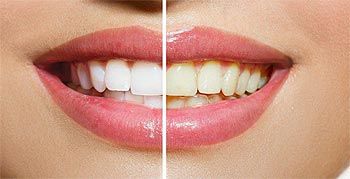 Blanqueamiento dental Santander