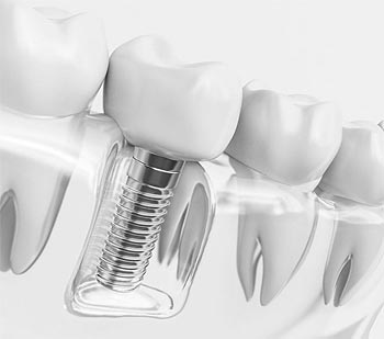Implantes dentales Santander