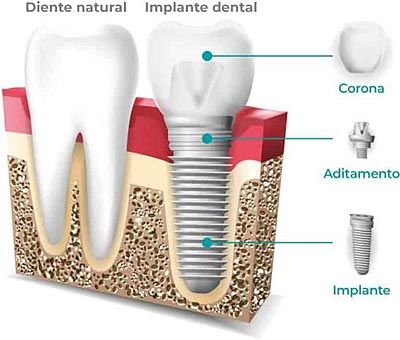 Implante dental Artdenta