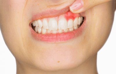 Tratamiento periodontal