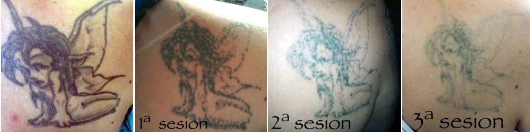 Proceso quitar un tatuaje