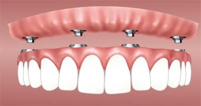 Dentadura fija sobre cuatro implantes