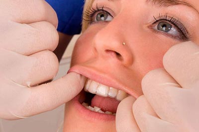 Qué es Invisalign