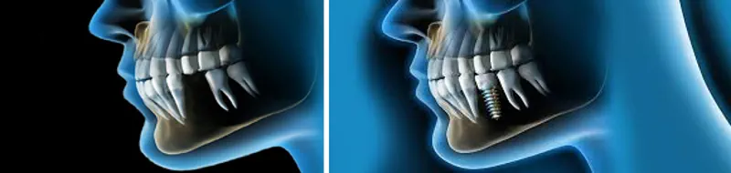Implantología dental en Tenerife