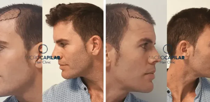 Microinjerto capilar para hombre
